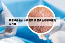 银屑病排名前十的医院 银屑病治疗哪家医院实力强