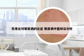 伤寒论对银屑病的论述 银屑病中医辩证分析