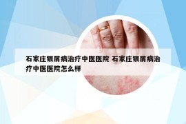 石家庄银屑病治疗中医医院 石家庄银屑病治疗中医医院怎么样