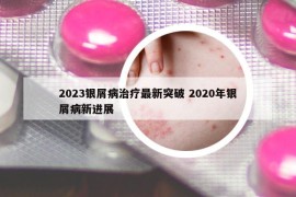 2023银屑病治疗最新突破 2020年银屑病新进展