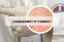 牛皮癣起皮削要好了吗 牛皮癣脱皮了