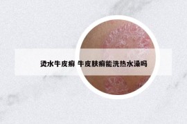 烫水牛皮癣 牛皮肤癣能洗热水澡吗