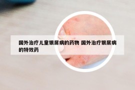国外治疗儿童银屑病的药物 国外治疗银屑病的特效药