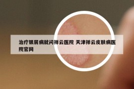 治疗银屑病就问祥云医院 天津祥云皮肤病医院官网