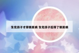 生完孩子才得银屑病 生完孩子后得了银屑病