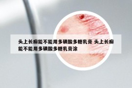 头上长癣能不能用多磺酸多糖乳膏 头上长癣能不能用多磺酸多糖乳膏涂
