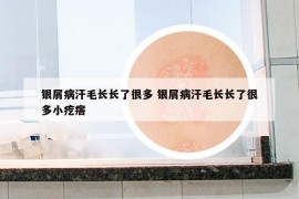 银屑病汗毛长长了很多 银屑病汗毛长长了很多小疙瘩
