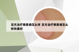豆方治疗银屑病怎么样 豆方治疗银屑病怎么样效果好