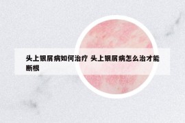 头上银屑病如何治疗 头上银屑病怎么治才能断根