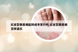红皮型银屑病能转成寻常行吗 红皮型银屑病怎样退红