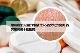 银屑病怎么治疗的最好舒心西安北方完美 西安银屑病十佳医院