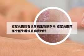 空军总医院有银屑病生物制剂吗 空军总医院那个医生看银屑病看的好