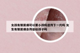 女孩有银屑病可以要小孩吗遗传下一代吗 女生有银屑病会传染给孩子吗