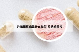 片状银屑病是什么类型 片状癣图片