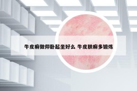 牛皮癣做仰卧起坐好么 牛皮肤癣多锻炼