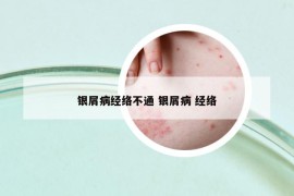银屑病经络不通 银屑病 经络