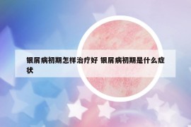银屑病初期怎样治疗好 银屑病初期是什么症状