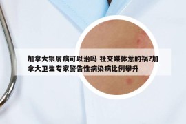 加拿大银屑病可以治吗 社交媒体惹的祸?加拿大卫生专家警告性病染病比例攀升