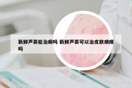 新鲜芦荟能治癣吗 新鲜芦荟可以治皮肤病痒吗