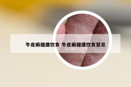 牛皮癣健康饮食 牛皮癣健康饮食禁忌