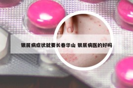 银屑病症状就要长春华山 银屑病医的好吗