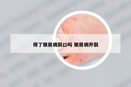 得了银屑病裂口吗 银屑病开裂