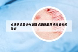 点滴状银屑病恢复期 点滴状银屑病多长时间能好