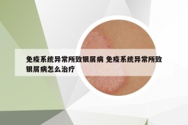 免疫系统异常所致银屑病 免疫系统异常所致银屑病怎么治疗