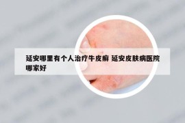 延安哪里有个人治疗牛皮癣 延安皮肤病医院哪家好