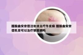 醋酸曲安奈德注射液治疗牛皮癣 醋酸曲安奈德乳膏可以治疗银屑病吗