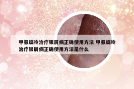 甲氨蝶呤治疗银屑病正确使用方法 甲氨蝶呤治疗银屑病正确使用方法是什么