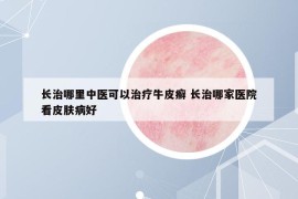 长治哪里中医可以治疗牛皮癣 长治哪家医院看皮肤病好