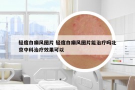 轻度白癞风图片 轻度白癞风图片能治疗吗北京中科治疗效果可以