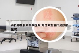 海口哪里有银屑病医院 海口大型治疗皮肤病医院