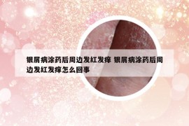 银屑病涂药后周边发红发痒 银屑病涂药后周边发红发痒怎么回事
