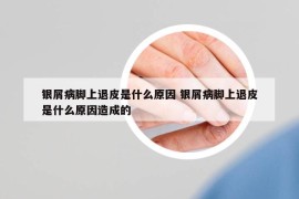 银屑病脚上退皮是什么原因 银屑病脚上退皮是什么原因造成的