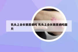 乳头上会长银屑病吗 乳头上会长银屑病吗图片