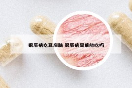 银屑病吃豆腐脑 银屑病豆腐能吃吗