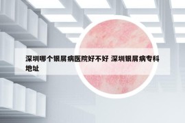 深圳哪个银屑病医院好不好 深圳银屑病专科地址