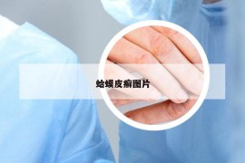 蛤蟆皮癣图片