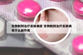 生物制剂治疗皮肤病症 生物制剂治疗皮肤病有什么副作用