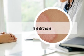 牛皮癣又叫啥