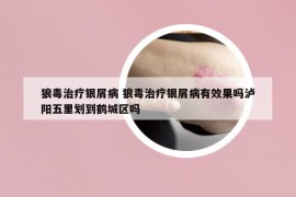 狼毒治疗银屑病 狼毒治疗银屑病有效果吗泸阳五里划到鹤城区吗