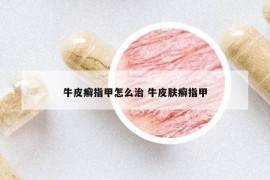 牛皮癣指甲怎么治 牛皮肤癣指甲