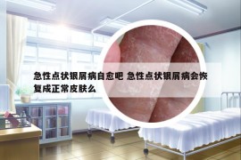 急性点状银屑病自愈吧 急性点状银屑病会恢复成正常皮肤么