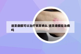 道圣康膜可以治疗银屑病么 道圣康膜能治病吗