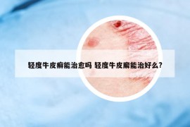轻度牛皮癣能治愈吗 轻度牛皮廨能治好么?