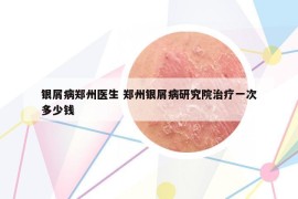 银屑病郑州医生 郑州银屑病研究院治疗一次多少钱