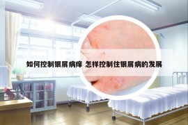 如何控制银屑病痒 怎样控制住银屑病的发展