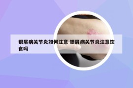 银屑病关节炎如何注意 银屑病关节炎注意饮食吗